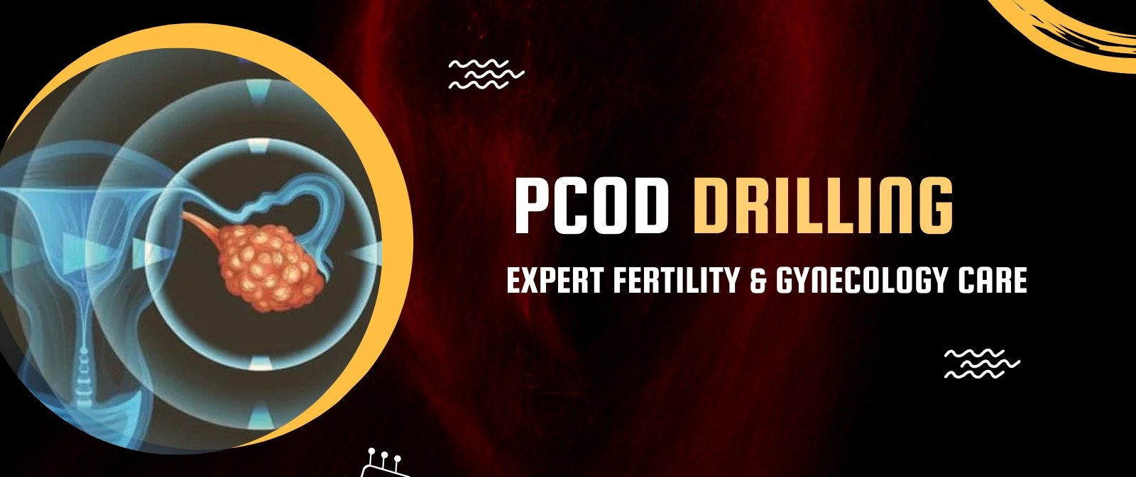 PCOD Drilling – A Solution for Ovulation Issues