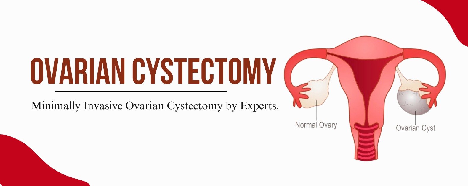 Ovarian Cystectomy at Dr. Patankar Clinic